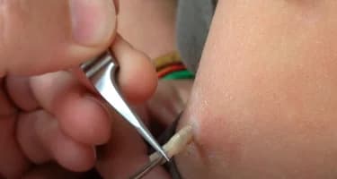 Российским туристам сообщили, как не привезти под кожей личинок из тропических стран