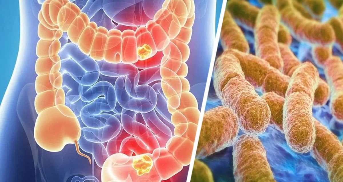 Выявлены 5 распространённых причин, стоящих за ростом заболеваемости раком кишечника