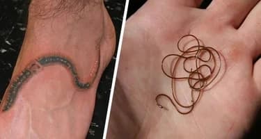 Российский турист привез из ЮВА под кожей мигрирующего паразита Российский турист привез из ЮВА под кожей мигрирующего паразита