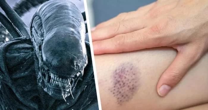 У российского туриста после отдыха в Таиланде нашли под кожей мигрирующую личинку паразита У российского туриста после отдыха в Таиланде нашли под кожей мигрирующую личинку паразита