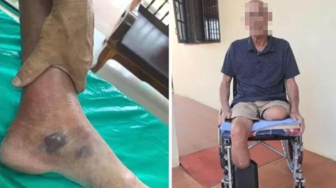 Из-за укуса комара турист потерял обе ноги на популярном у россиян курорте