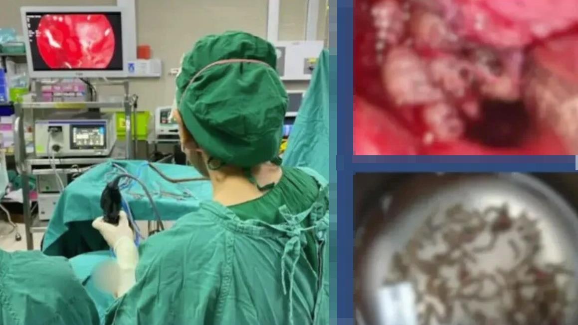 В Таиланде женщина с насморком обратилась к врачу, но из носа на шокированного медика полезли сотни личинок насекомых